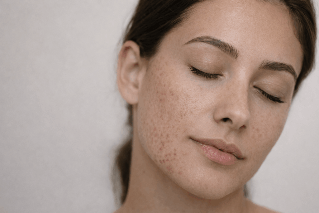 microneedling treatment surrey