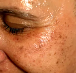 pigmented spots on the face