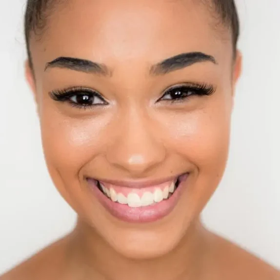 Gummy Smile Treatment Surrey