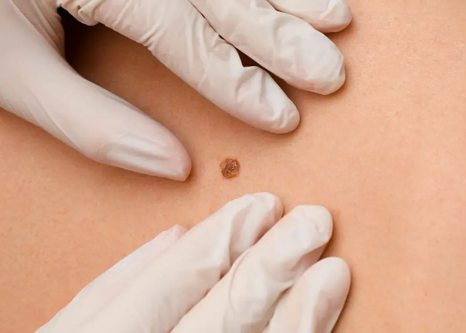 Minor Surgery Surrey