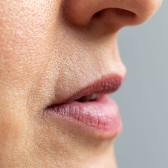 Nasolabial Fillers Surrey