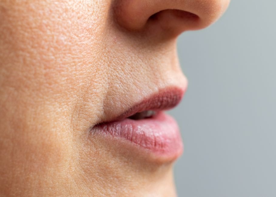 Nasolabial Fillers Surrey