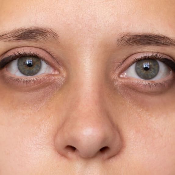 Tear Trough Filler Surrey
