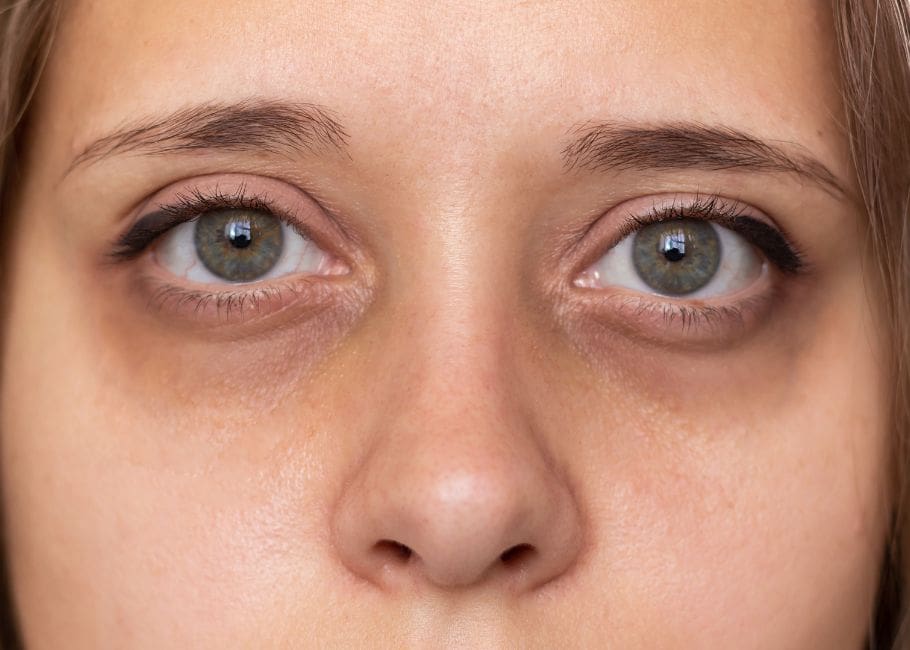 Tear Trough Filler Surrey