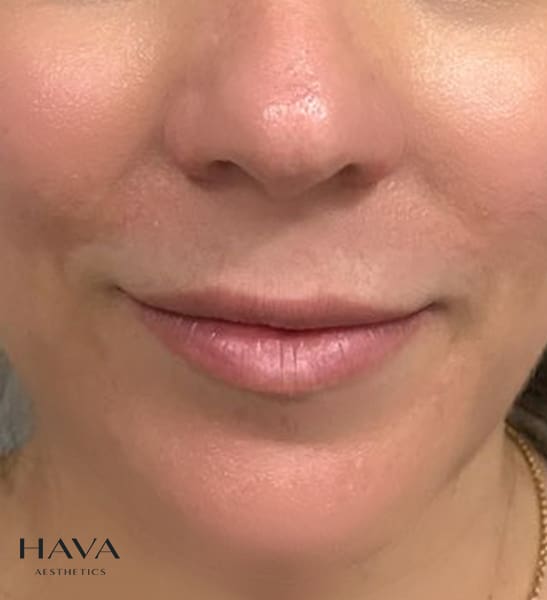 Lip Filler Surrey Before