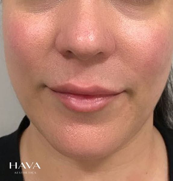 Lip-filler-esher-surrey-AFTER