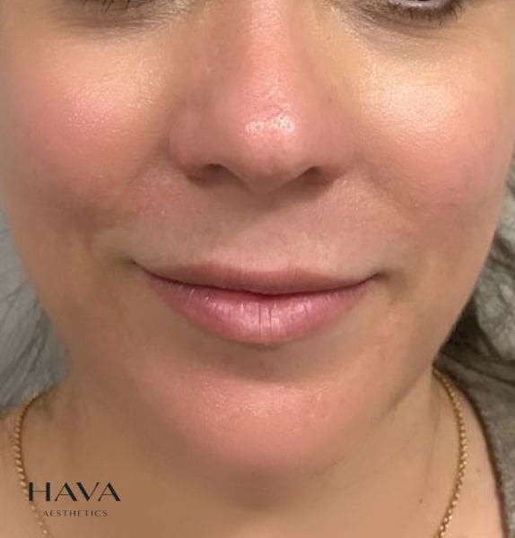 Lip-filler-esher-surrey-BEFORE