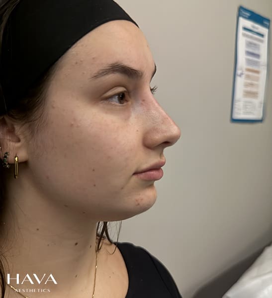non surgical rhinoplasty surrey after
