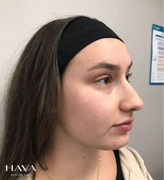 non surgical rhinoplasty surrey before