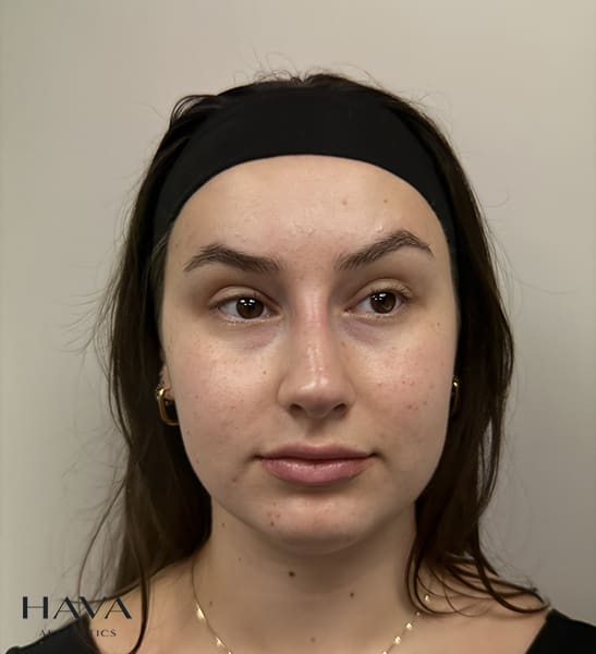 non surgical rhinoplasty surrey after