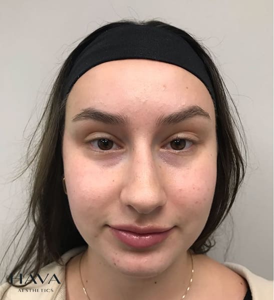 non surgical rhinoplasty surrey before