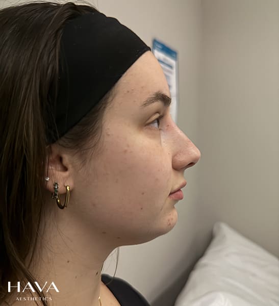 non surgical rhinoplasty surrey after