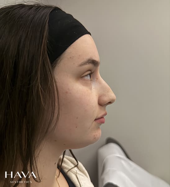 non surgical rhinoplasty surrey before
