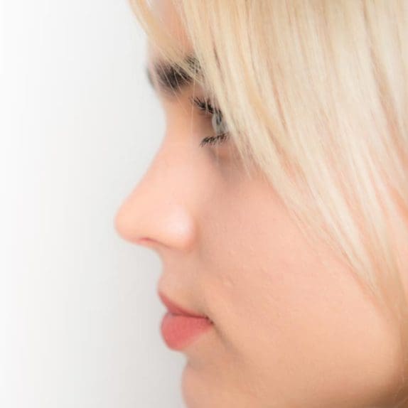 Non-Surgical Rhinoplasty