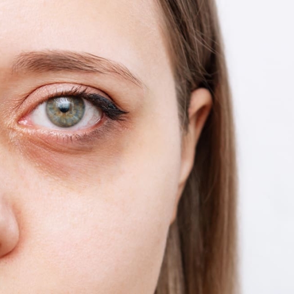 Tired Eyes