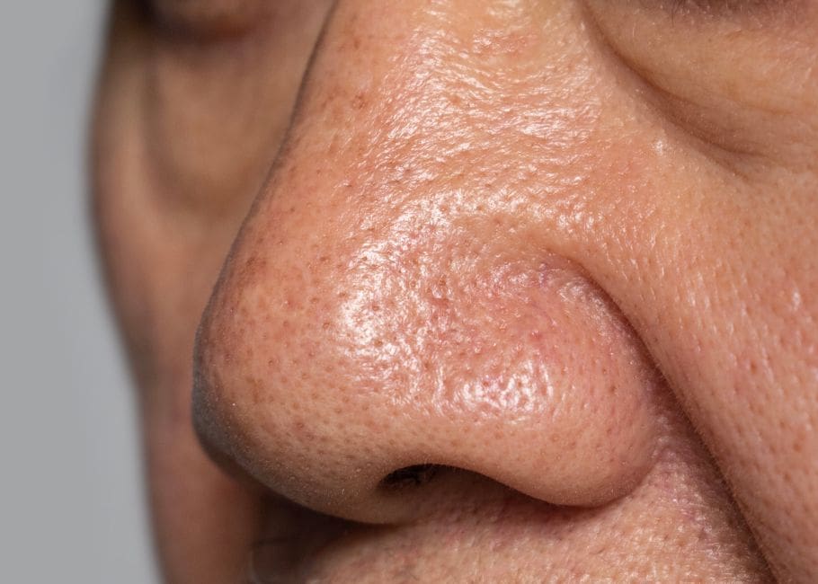 close up of asian man nose before treatment