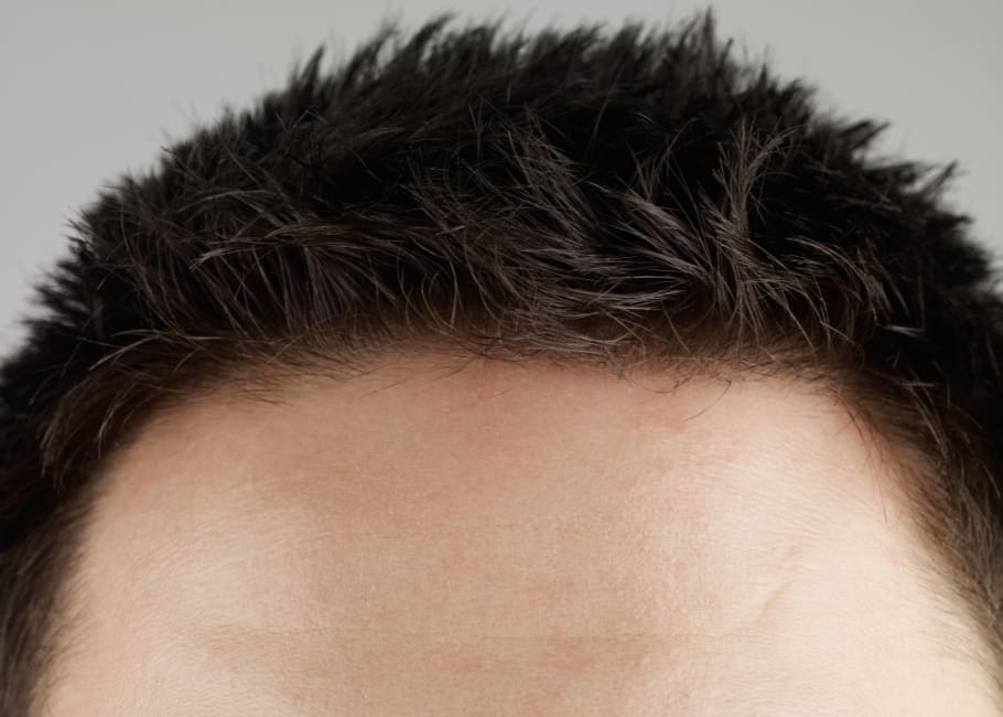 man after forehead treatment