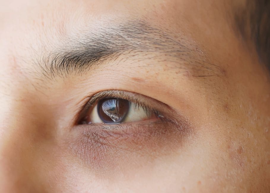 man with dark circles around eyes