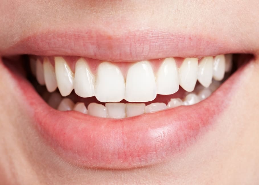 woman after gummy smile treatment