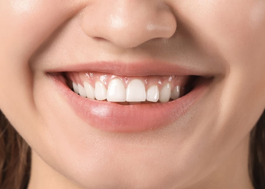woman before getting gummy smile treatment