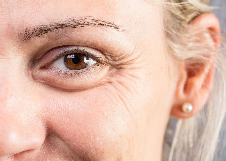 woman displaying wrinkles around her eyes