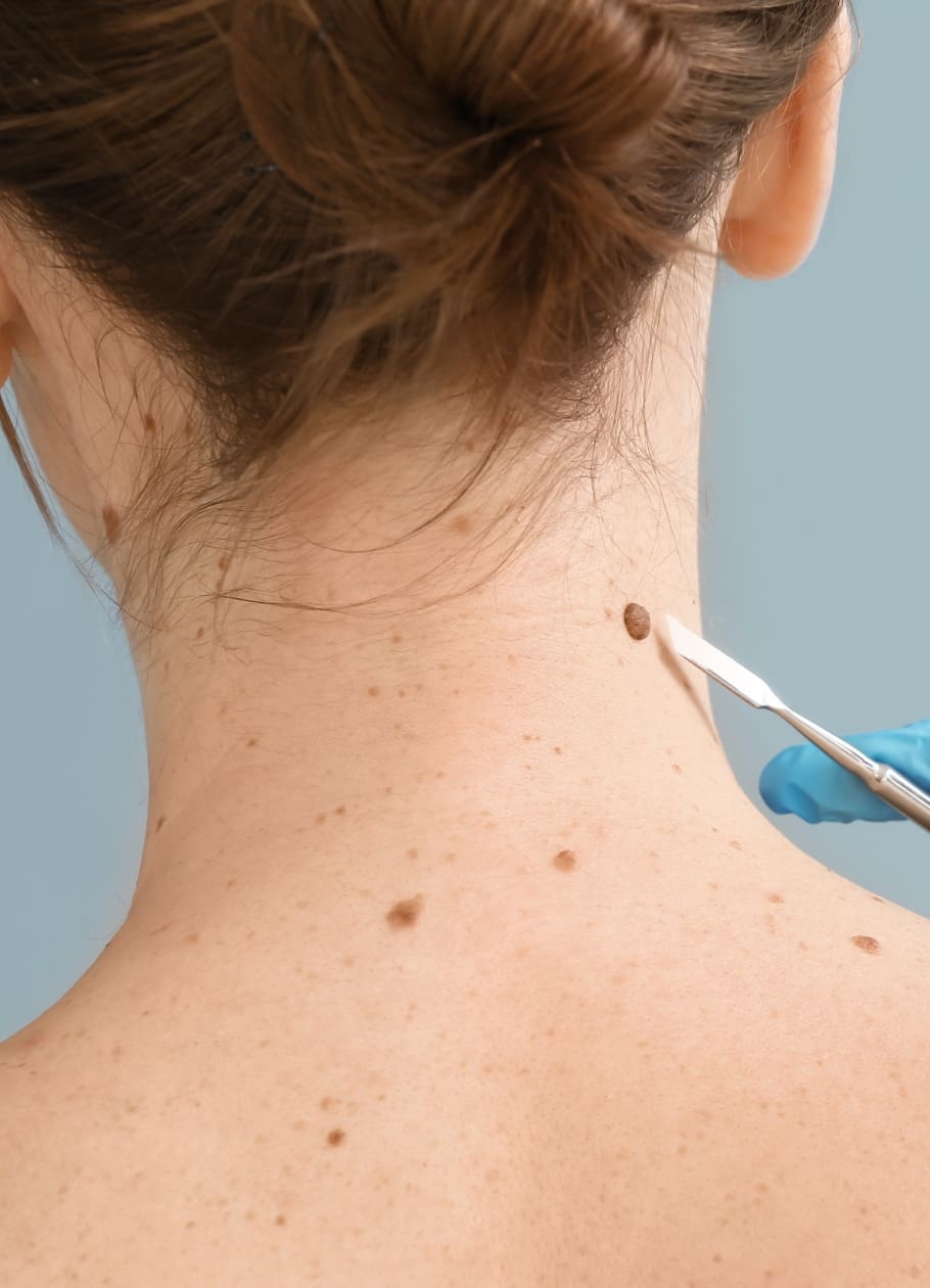 woman getting mole removed