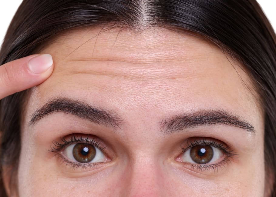 woman pointing to her forehead lines