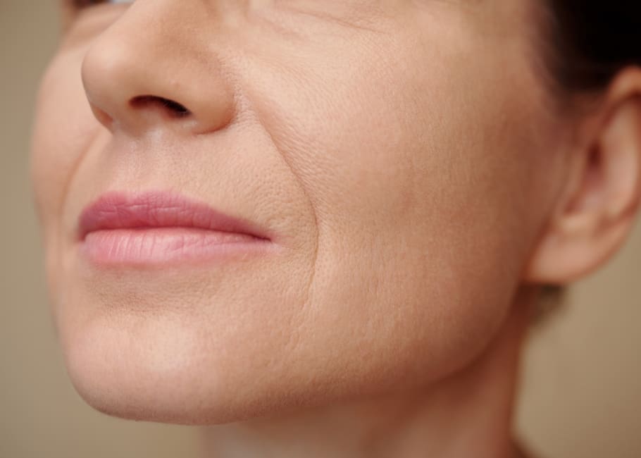 woman with nasolabial folds