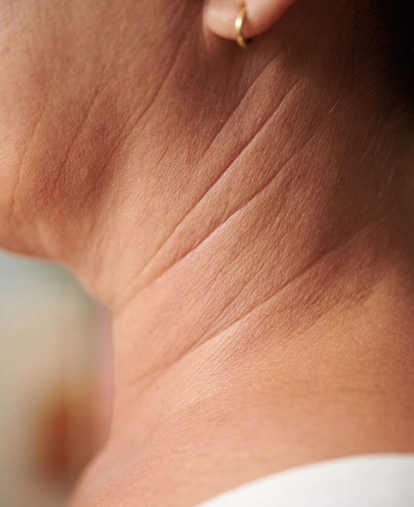 woman with neck wrinkles