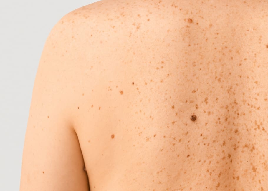 woman with skin moles on back