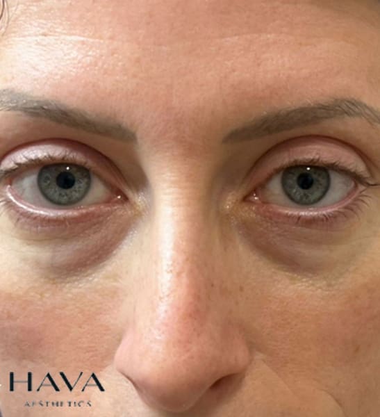 PN Eyes V2 BEFORE treatment