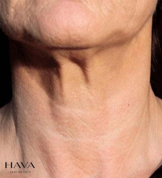 polynucleotides neck esher surrey after