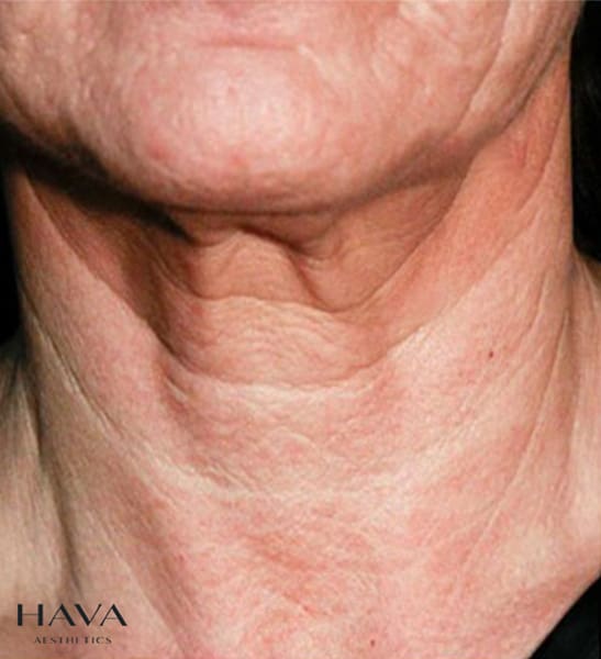 polynucleotides neck esher surrey before