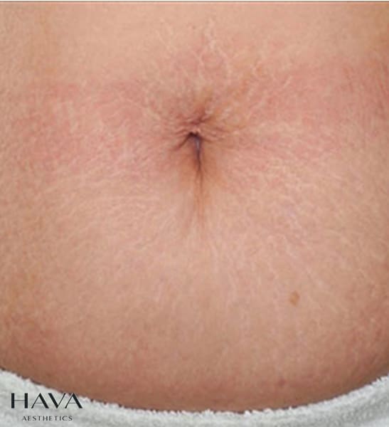 skinpen esher , surrey