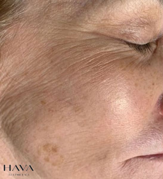 SkinPen Face AFTER treatment