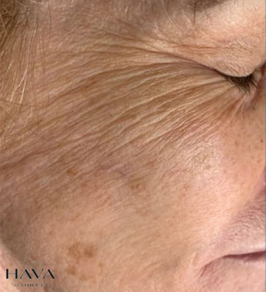SkinPen Face BEFORE treatment