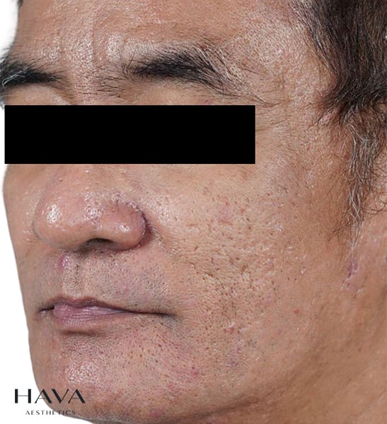 microneedling skinpen esher, surrey