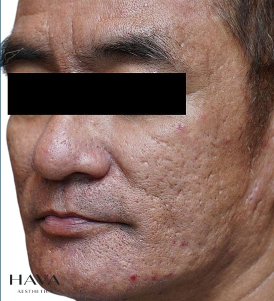 microneedling skinpen esher, surrey