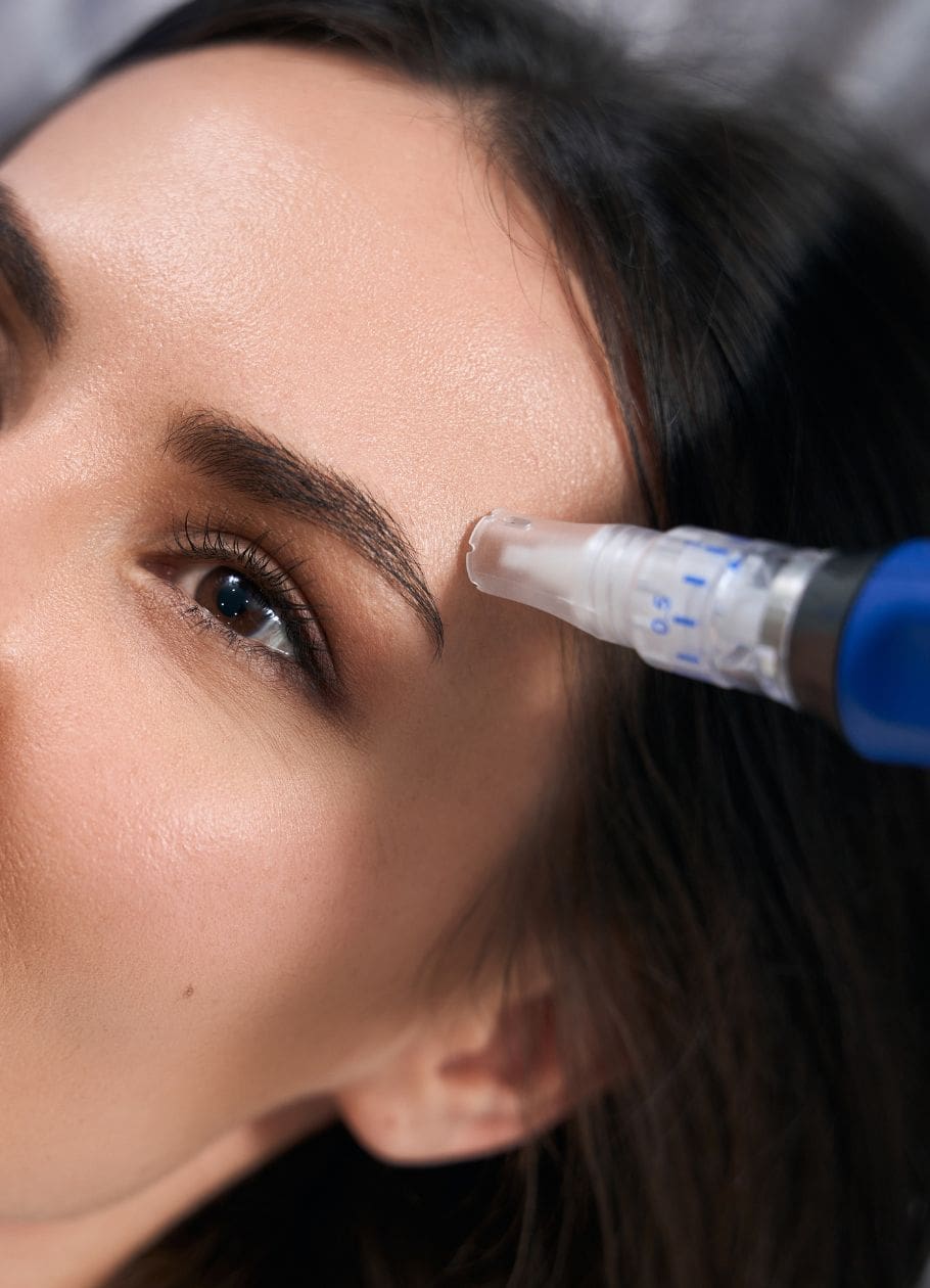 microneedling skin treatment