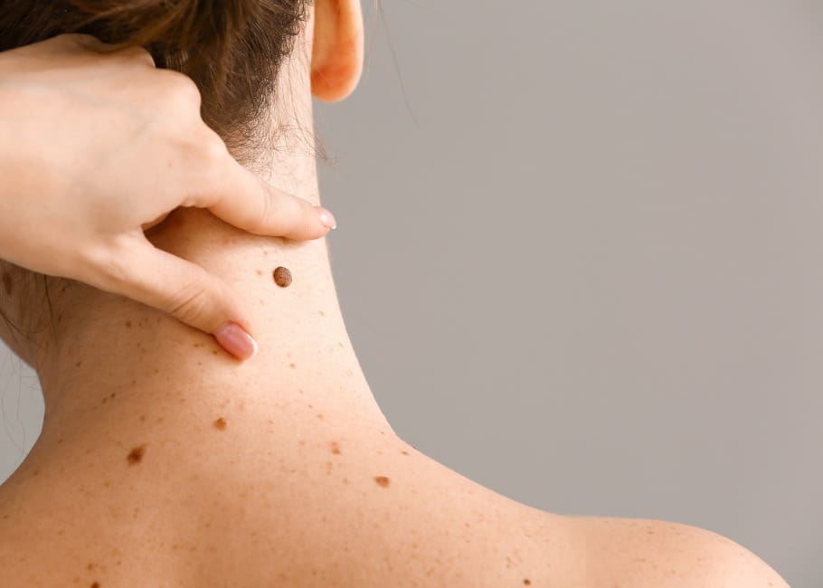 mole removal surrey