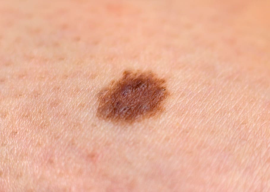 mole removal surrey