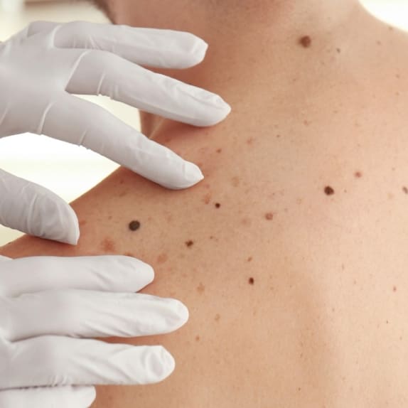 Mole Removal Surrey