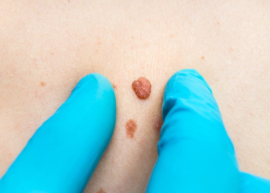 Close-up of raised skin tag being examined