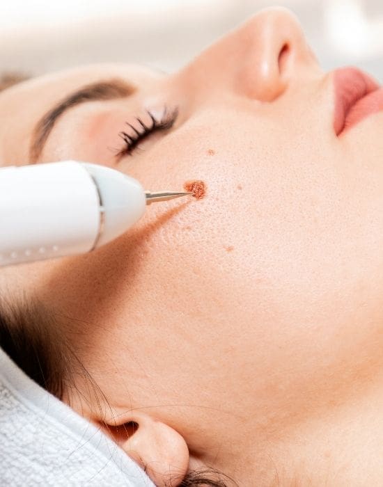 CryoPen skin lesion removal treatment on face
