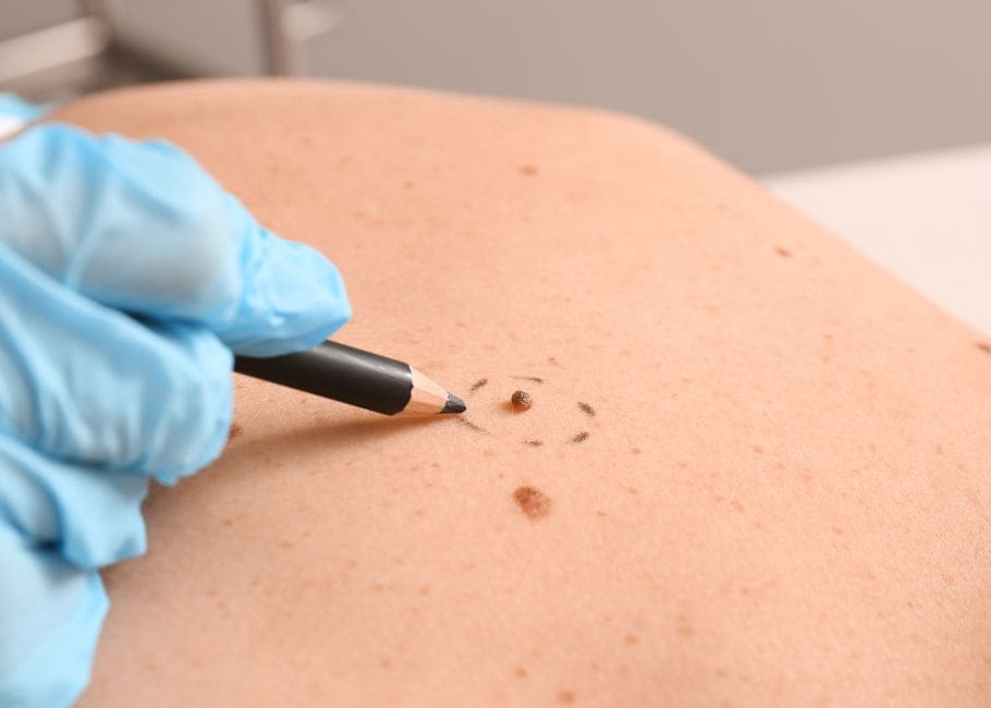 Dermatologist Applying Marks onto Patient's Skin, Closeup