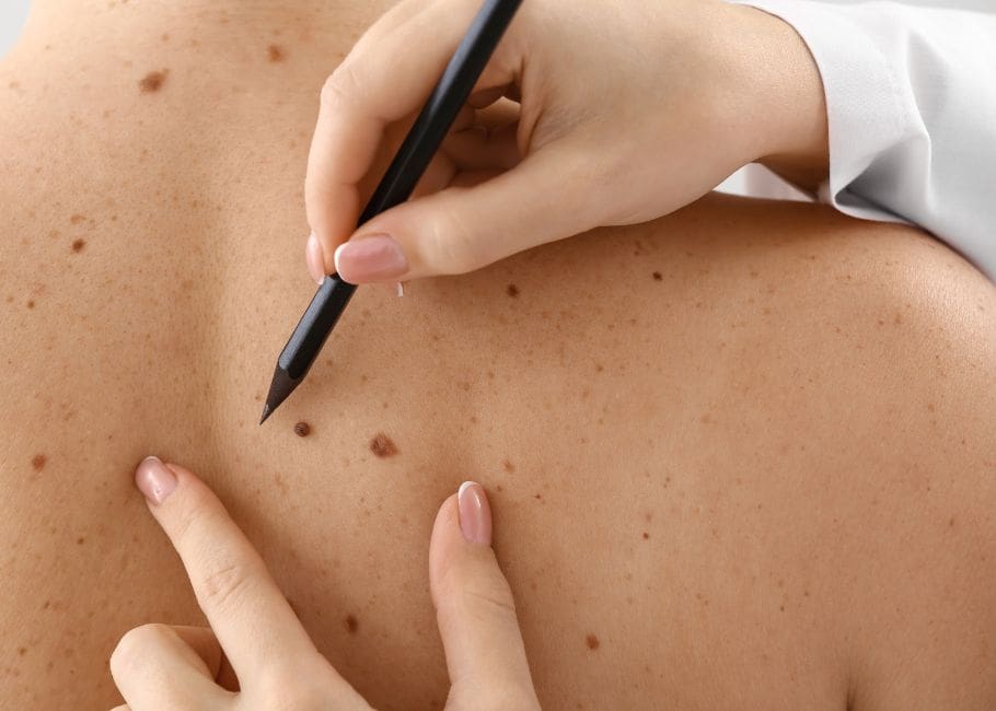 Dermatologist Applying Marks onto Patient's Skin before skin tag Removal, Closeup