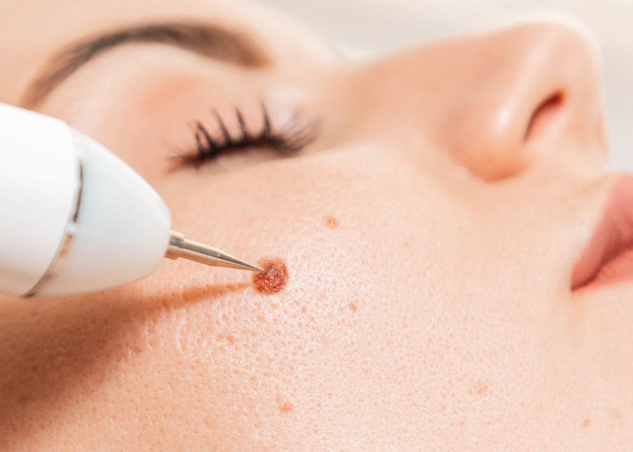 HAVA-Woman getting wart removed