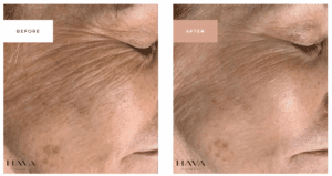 MICRONEEDLING BEFORE AND AFTER FACIAL AREA
