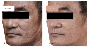 MICRONEEDLING BEFORE AND AFTER FULL FACE