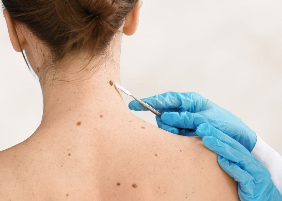 Skin Tag removal with surgical instrument on back of neck